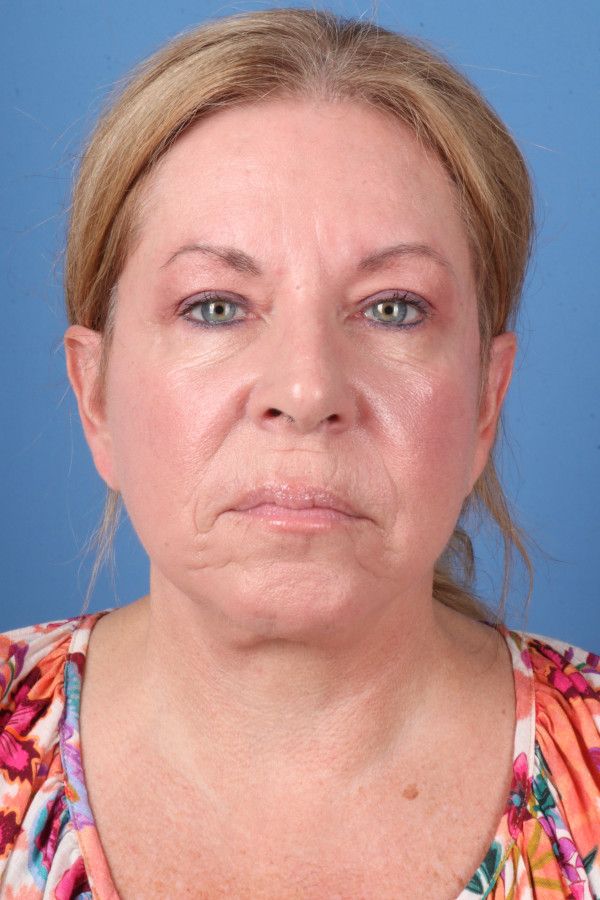 Facelift Before & After Image
