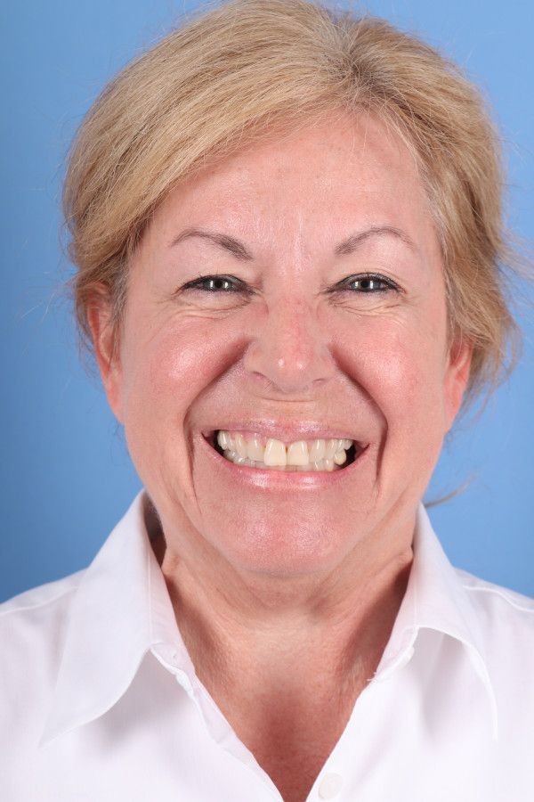 Facelift Before & After Image