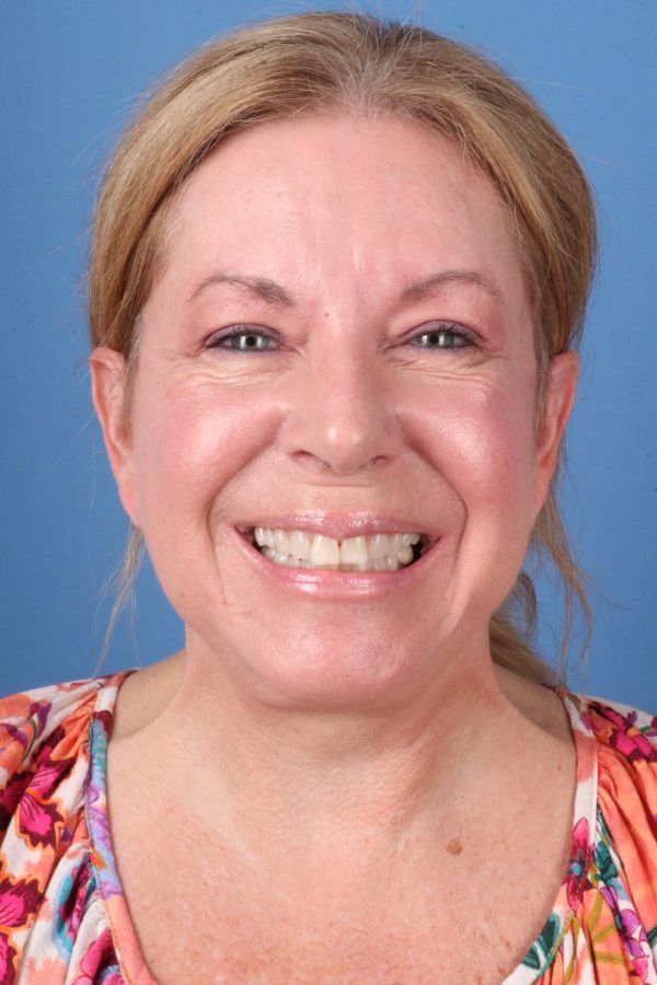 Facelift Before & After Image
