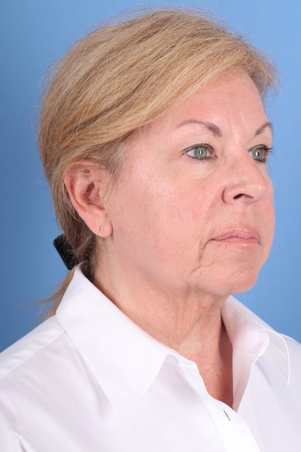 Facelift Before & After Image