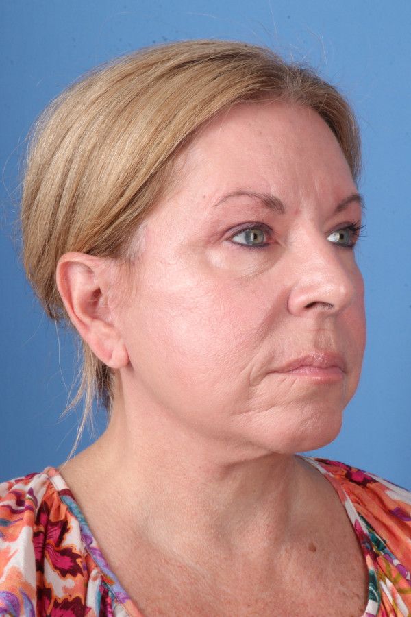 Facelift Before & After Image