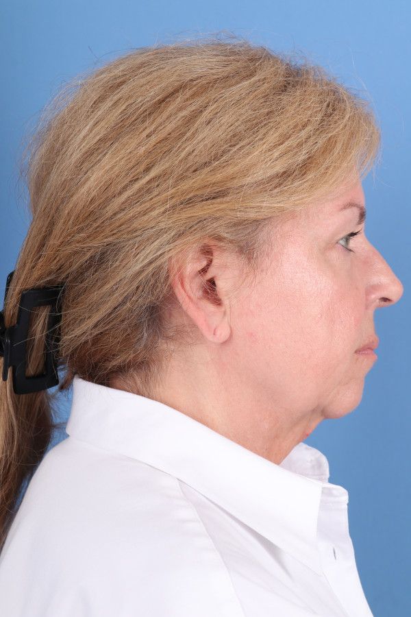 Facelift Before & After Image
