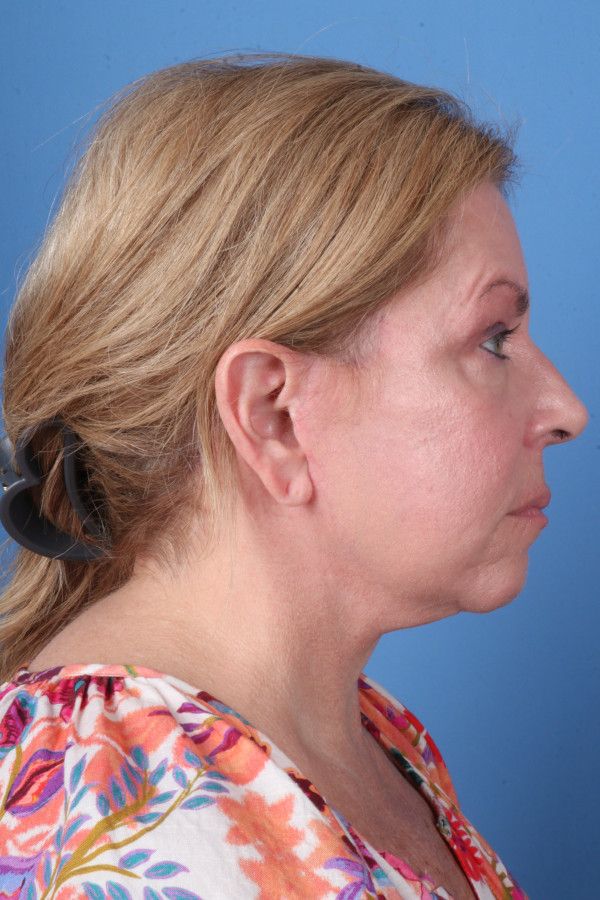 Facelift Before & After Image