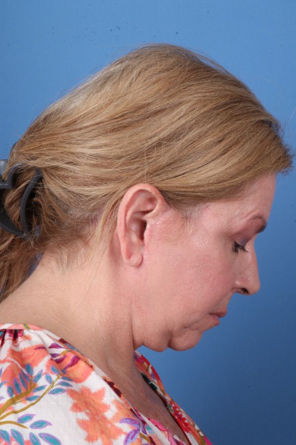 Facelift Before & After Image