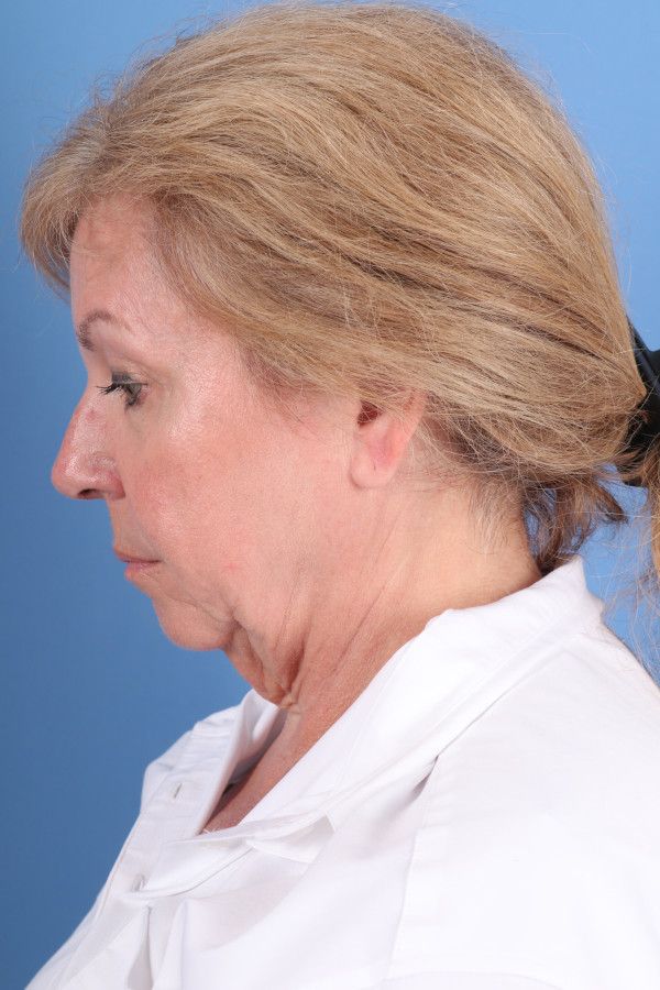 Facelift Before & After Image