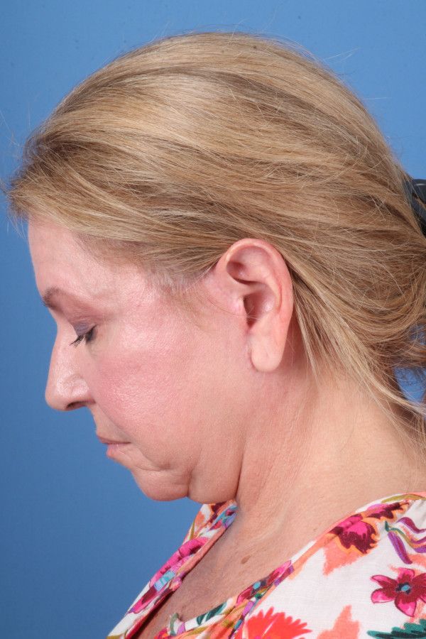 Facelift Before & After Image