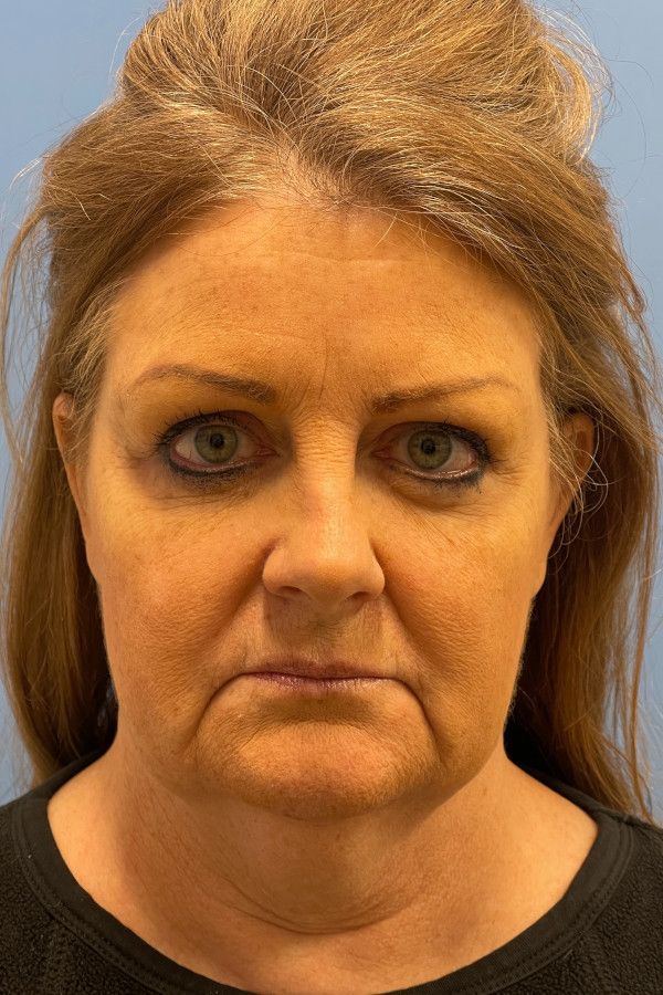 Facelift Before & After Image