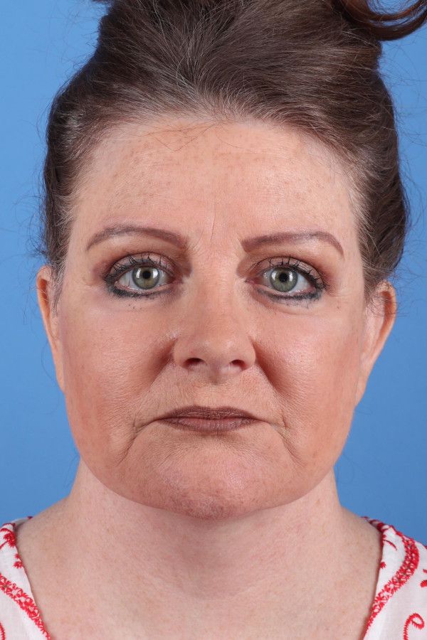 Facelift Before & After Image