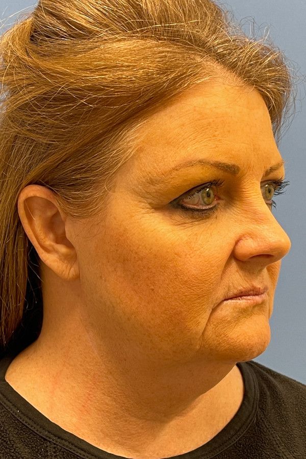 Facelift Before & After Image