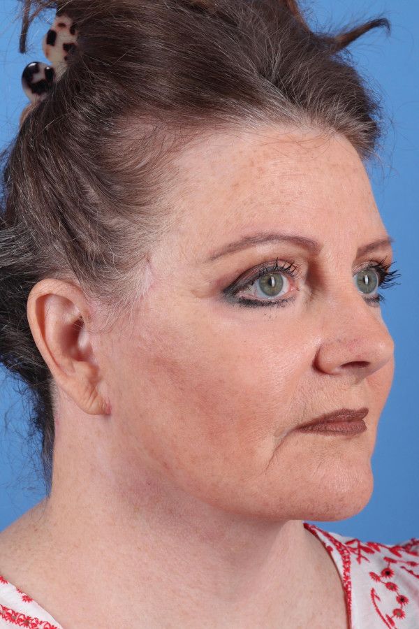 Facelift Before & After Image