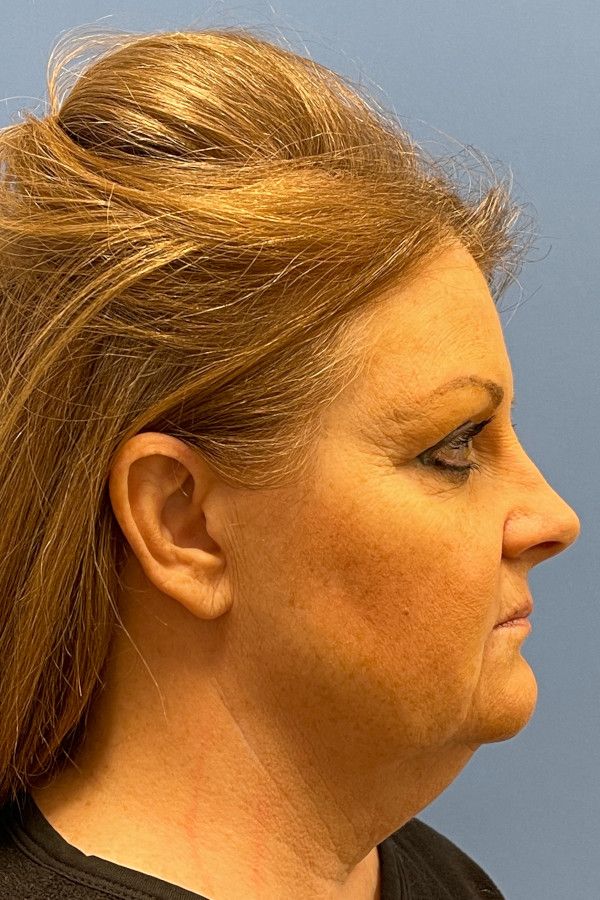 Facelift Before & After Image