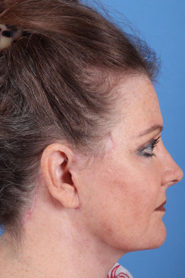 Facelift Before & After Image