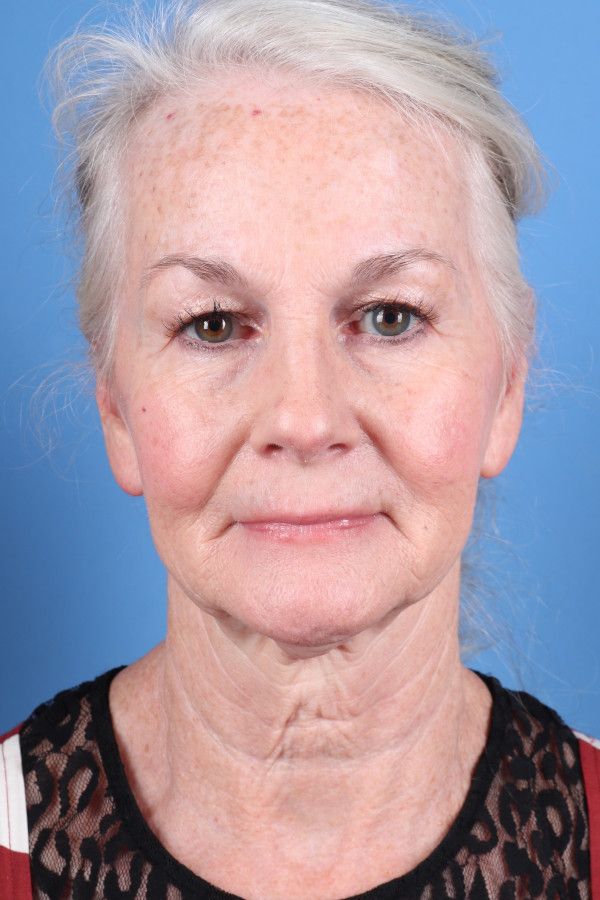 Facelift Before & After Image