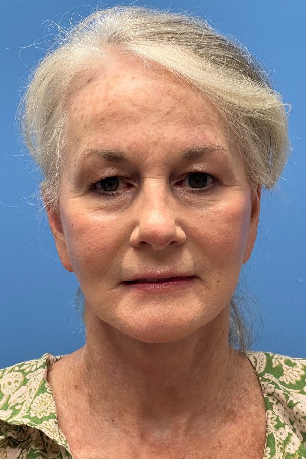 Facelift Before & After Image