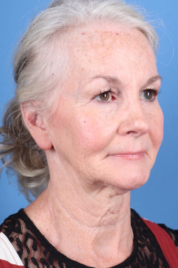 Facelift Before & After Image