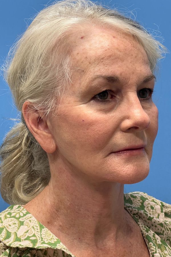 Facelift Before & After Image