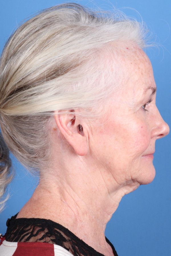 Facelift Before & After Image