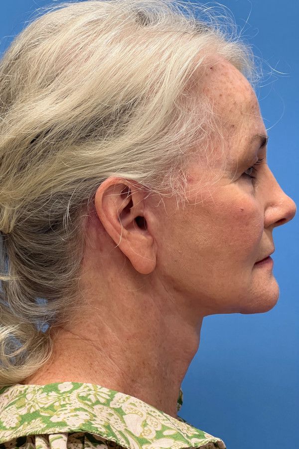 Facelift Before & After Image
