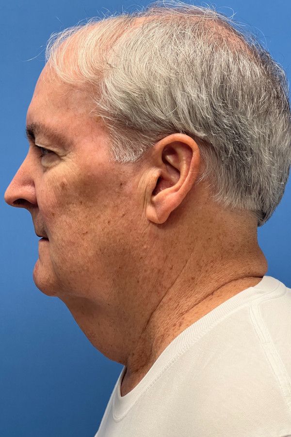 Facelift Before & After Image