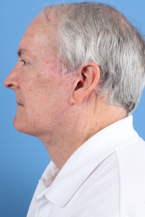 Facelift Before & After Image