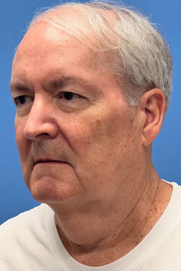 Facelift Before & After Image