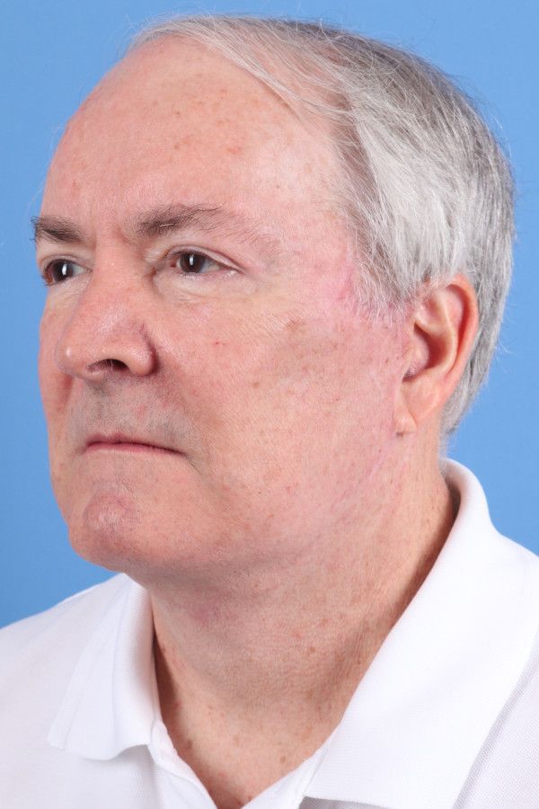 Facelift Before & After Image