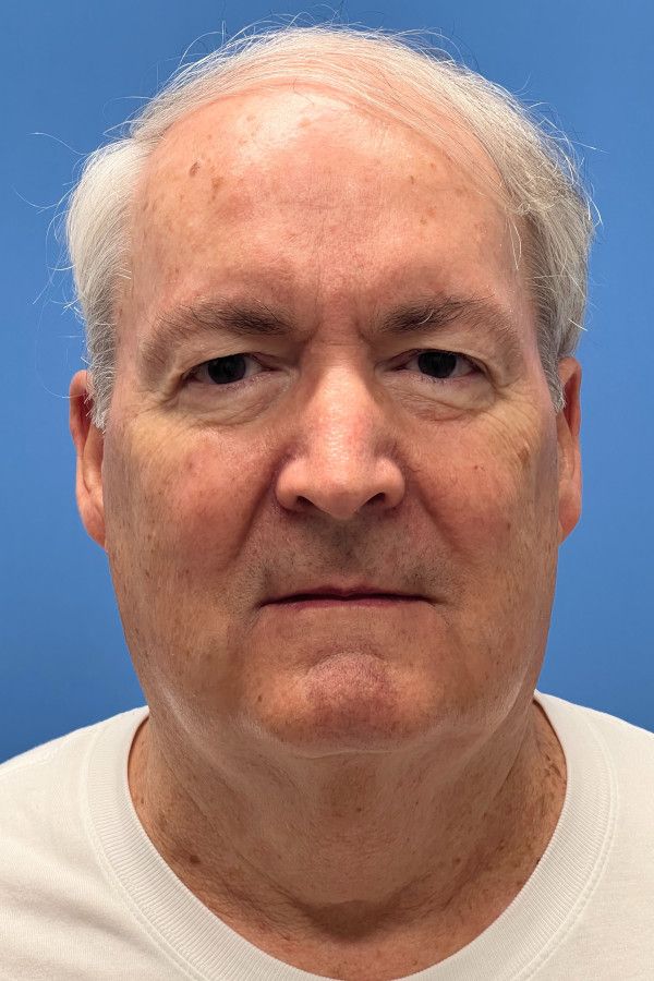 Facelift Before & After Image