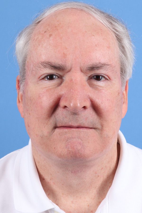 Facelift Before & After Image