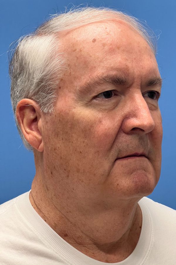 Facelift Before & After Image