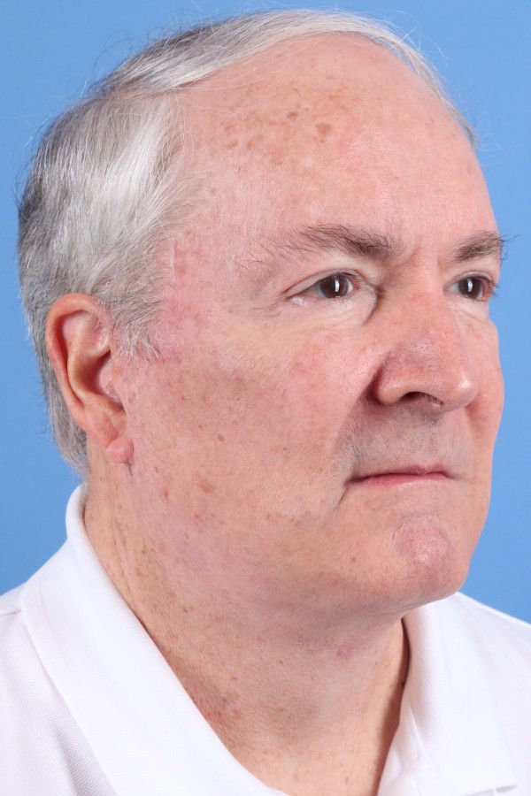 Facelift Before & After Image
