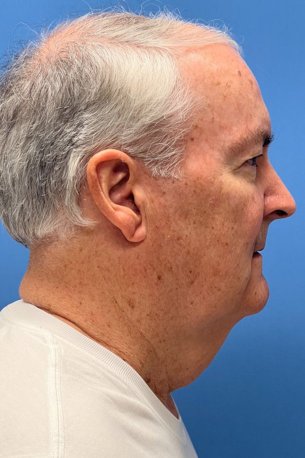 Facelift Before & After Image