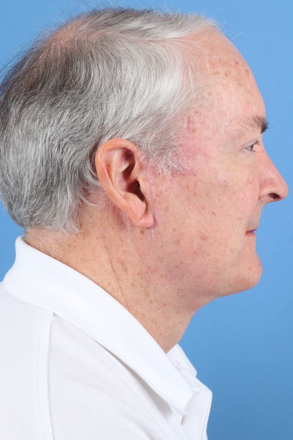 Facelift Before & After Image