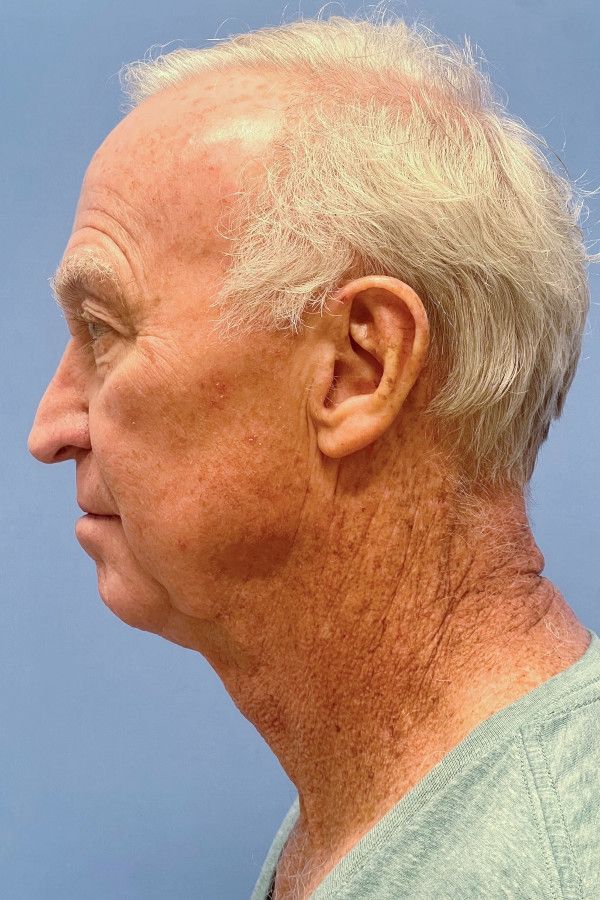 Facelift Before & After Image