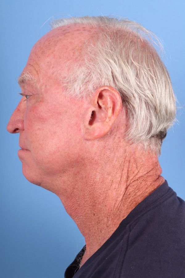 Facelift Before & After Image