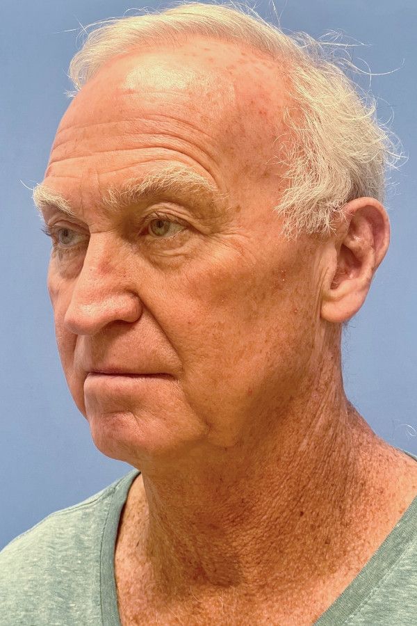 Facelift Before & After Image