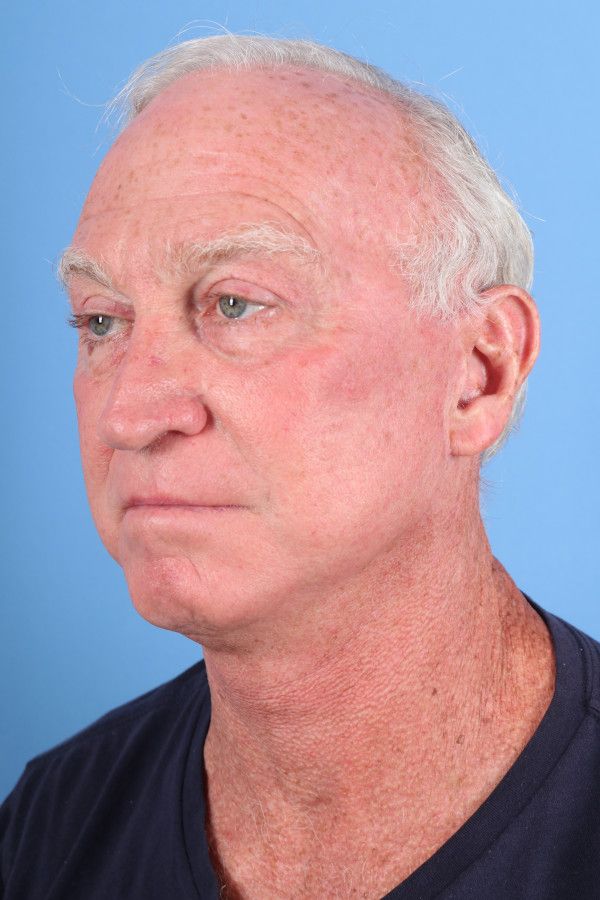 Facelift Before & After Image