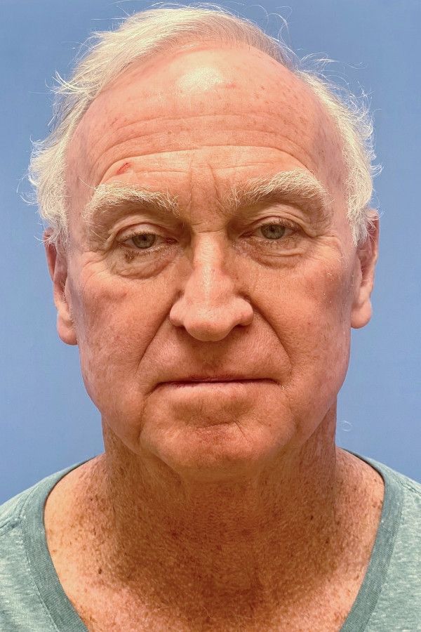 Facelift Before & After Image