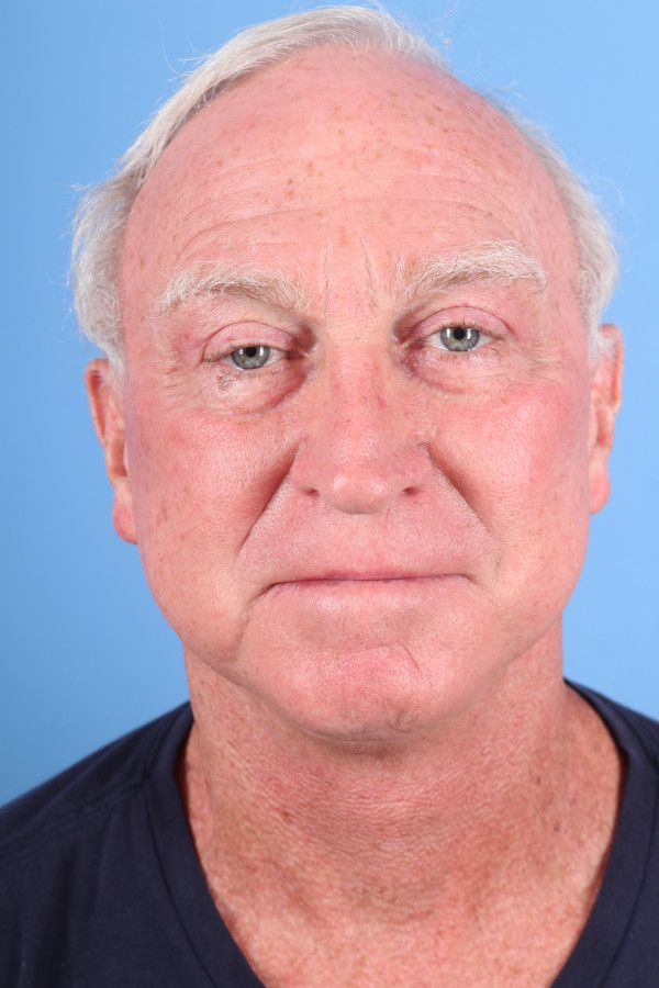 Facelift Before & After Image
