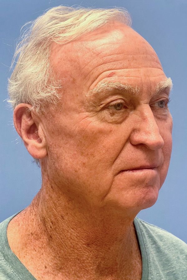 Facelift Before & After Image
