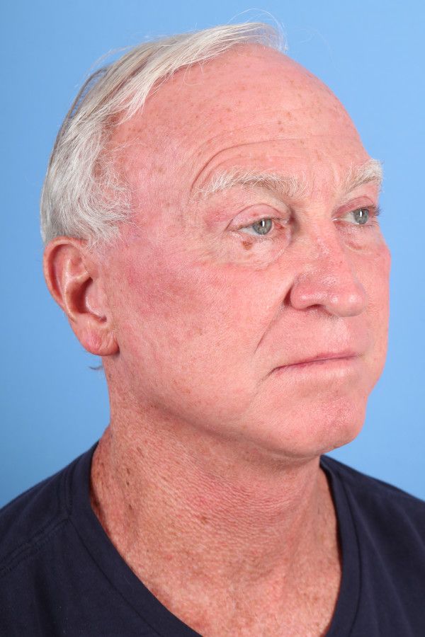 Facelift Before & After Image