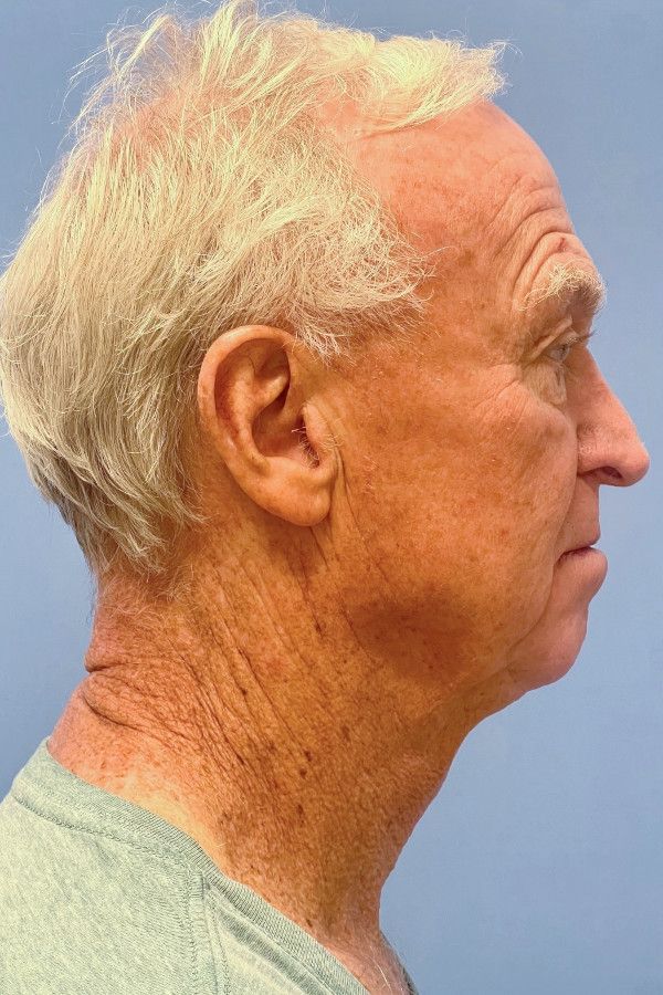 Facelift Before & After Image