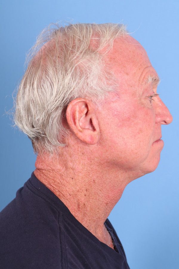 Facelift Before & After Image