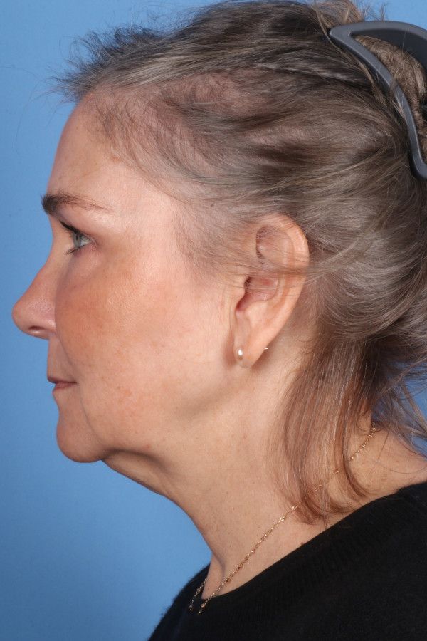 Facelift Before & After Image