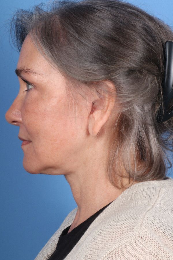 Facelift Before & After Image