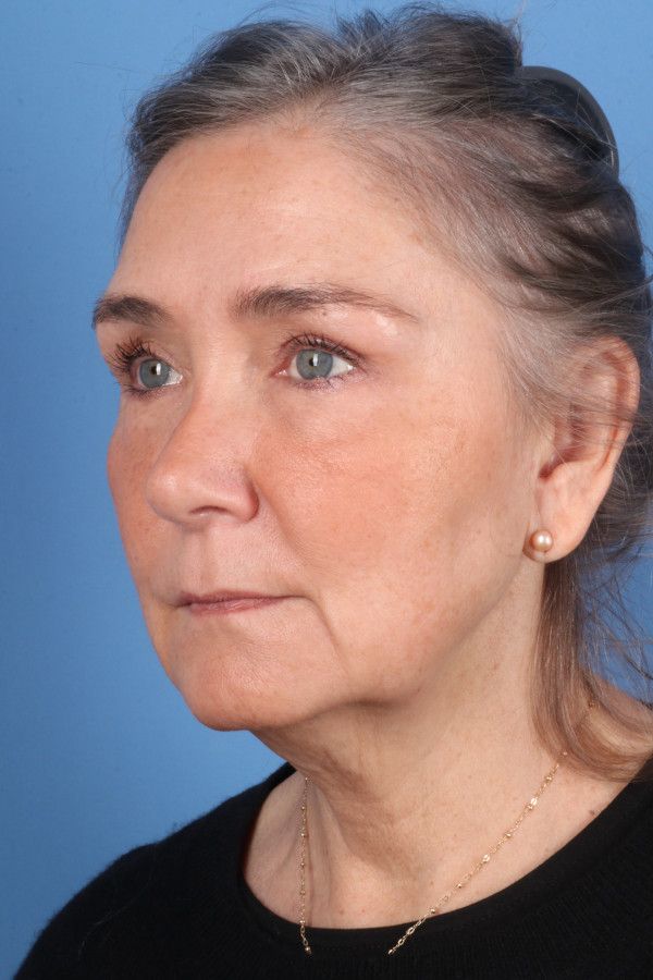 Facelift Before & After Image