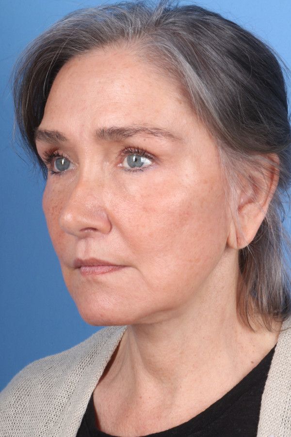 Facelift Before & After Image