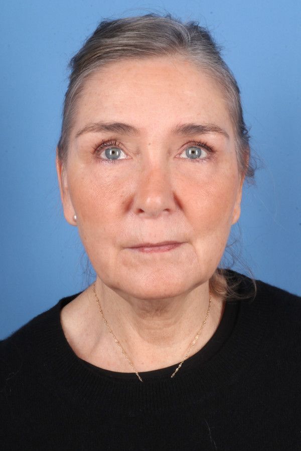 Facelift Before & After Image