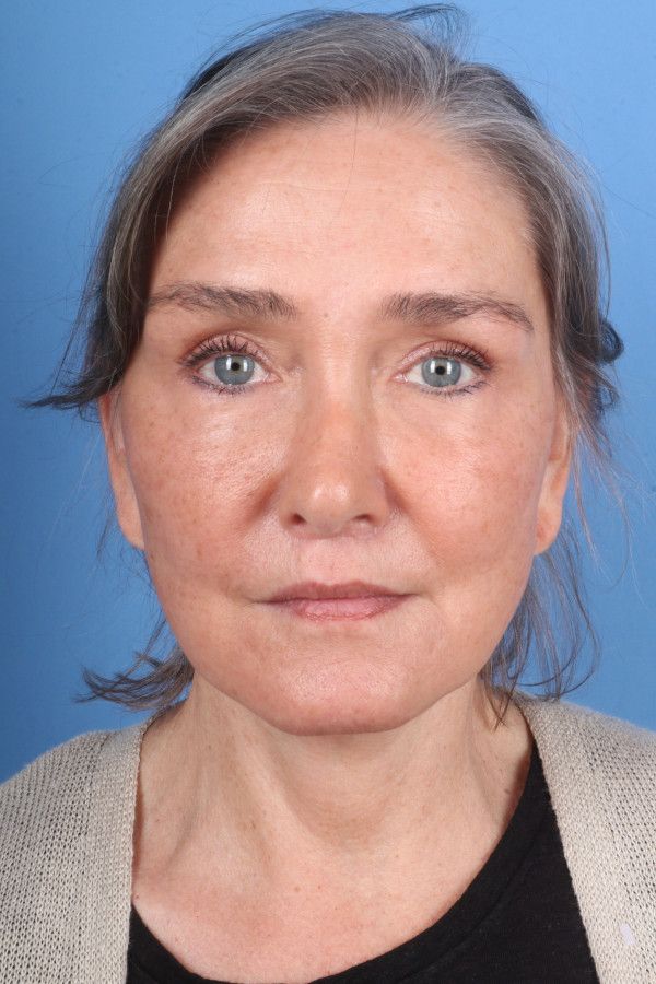 Facelift Before & After Image