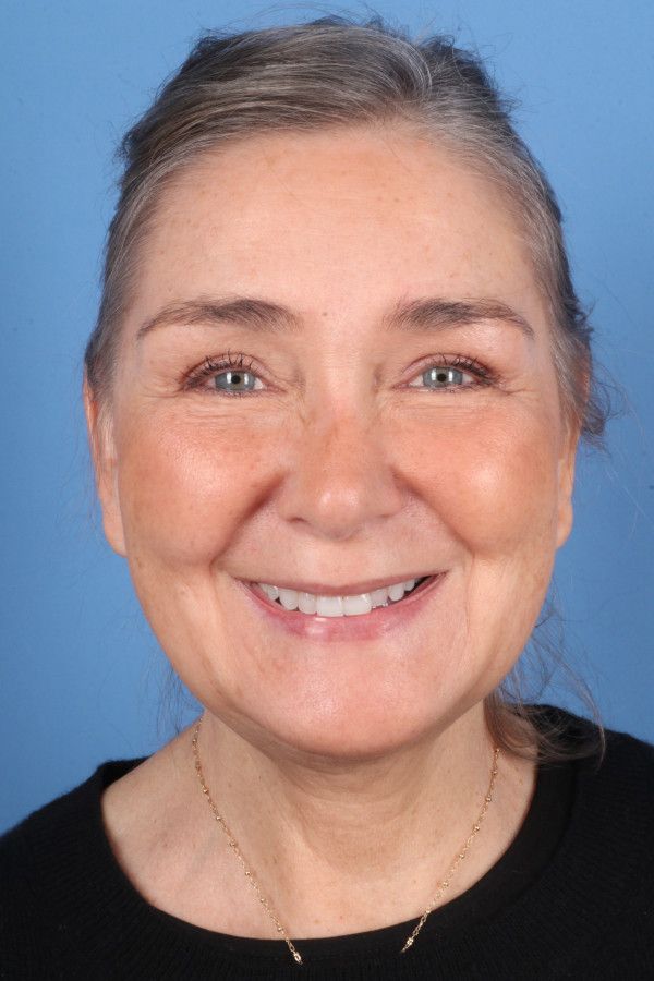Facelift Before & After Image