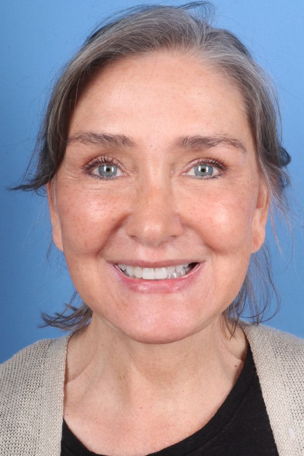Facelift Before & After Image